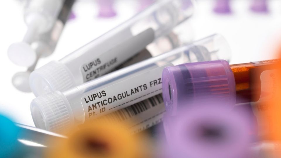 Lupus Nedir, Ne demek? Pozitif Lupus Hastal Nedir?